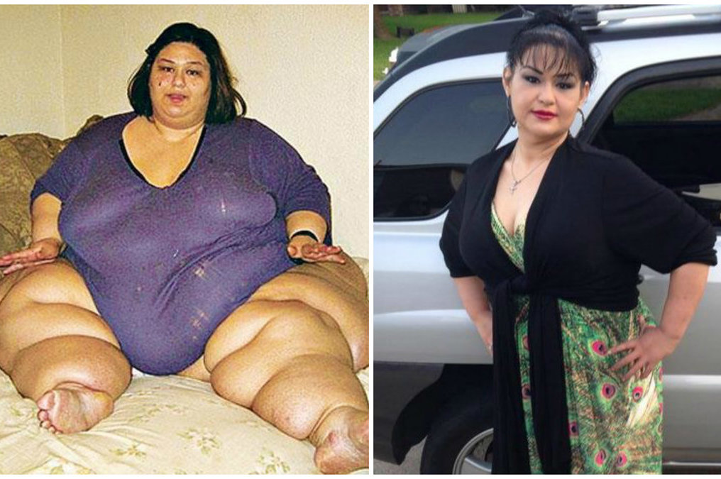 Storiausia Pasaulyje Moteris Atsikratė 400 Kilogramų Nuotraukose Neatpazįstama Tv3 Lt